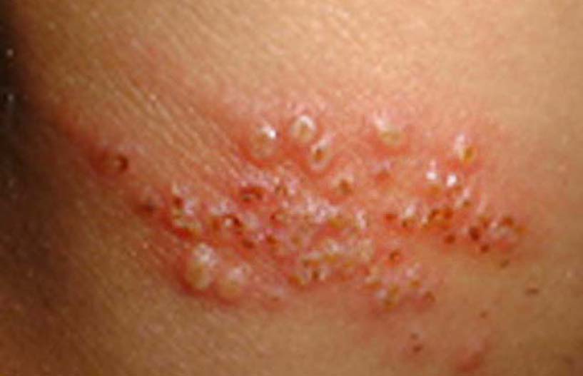 temperature papillomi virus kakoy pogibaet pri vsetaki При какой температуре погибает вирус папилломы фото
