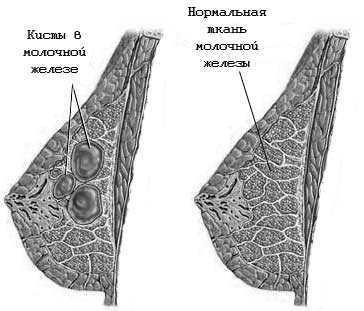 мастопатия мастопатия