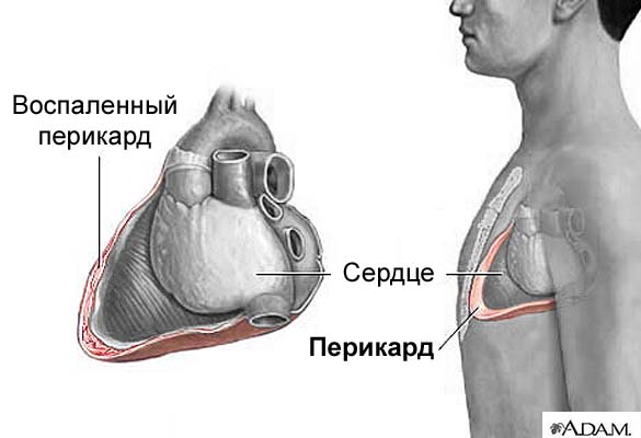 Перикардит: симптомы, диагностика, лечение - diagnos.ru.