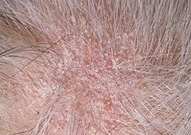 фото: хроническая трихофития волосистой части головы