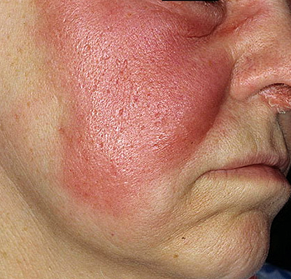 фото рожистое воспаление на лице