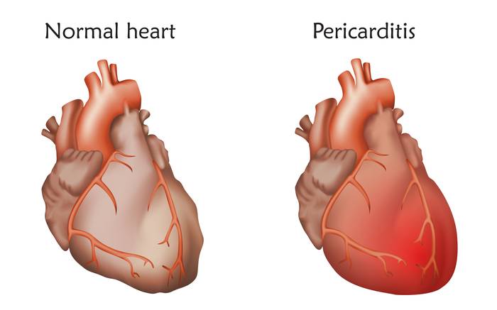 нормальное сердце и сердце с воспаленным перикардом