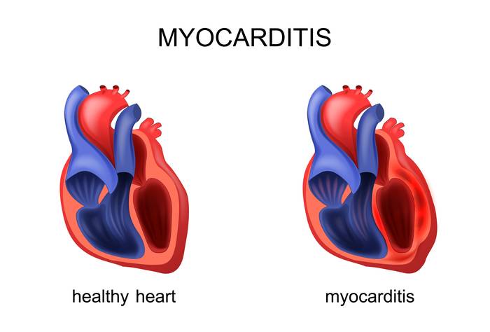 здоровое сердце и сердце при миокардите
