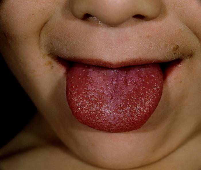 фото малиновый язык при скарлатине